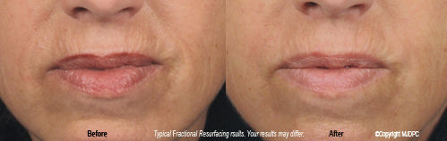 fractional_resurfacing1