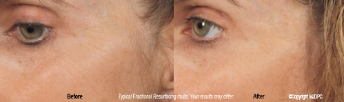 fractional_resurfacing2