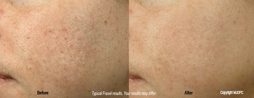 fraxel1