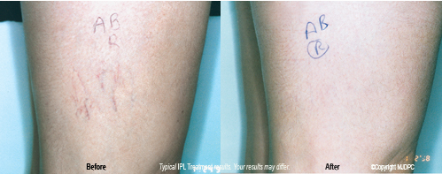 ipl_leg_vein_treatments1