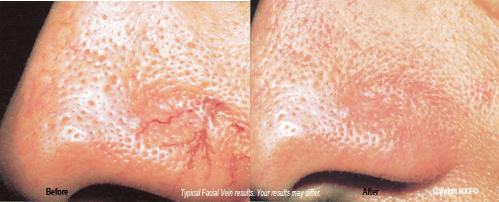 aesthetic_laser_treatments3