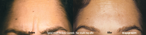 botox_cosmetic3