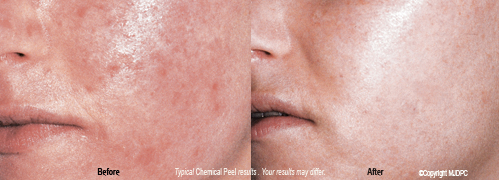 chemical_peels2