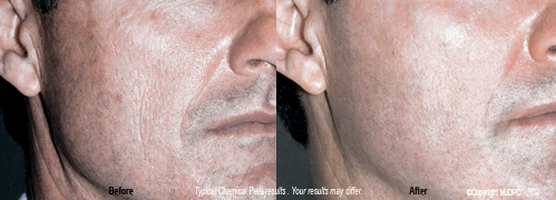 chemical_peels3