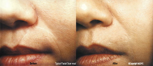 facial_scars1