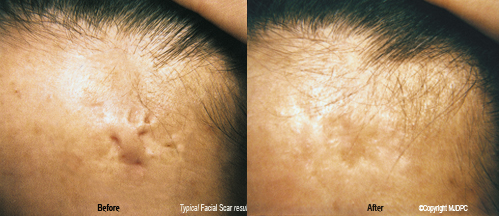 facial_scars3