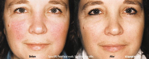 ipl_photo_facial_rejuvenation1
