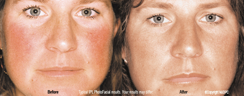 ipl_photo_facial_rejuvenation2