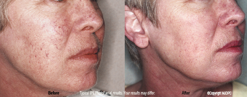 ipl_photo_facial_rejuvenation3