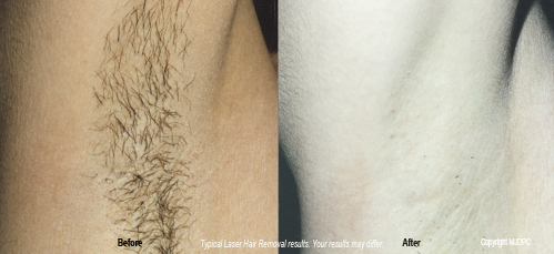 laser_hair_removal2