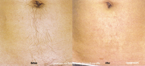 laser_hair_removal3
