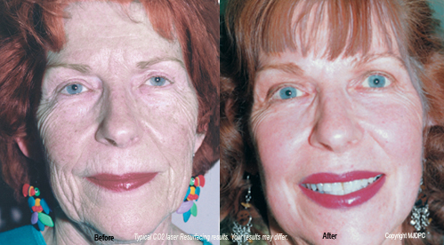 laser_skin_resurfacing2