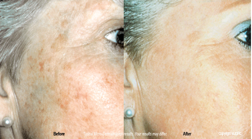 microdermabrasion1