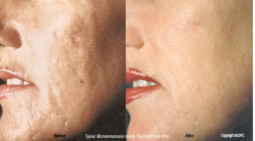 microdermabrasion2