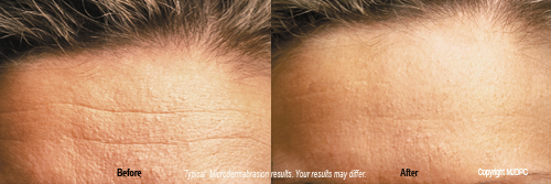 microdermabrasion3