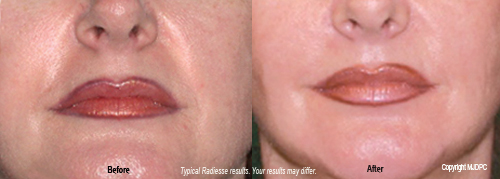 radiesse3