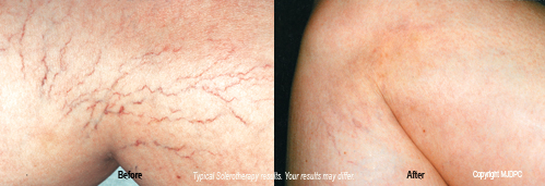 sclerotherapy1