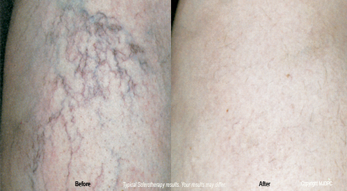 sclerotherapy3
